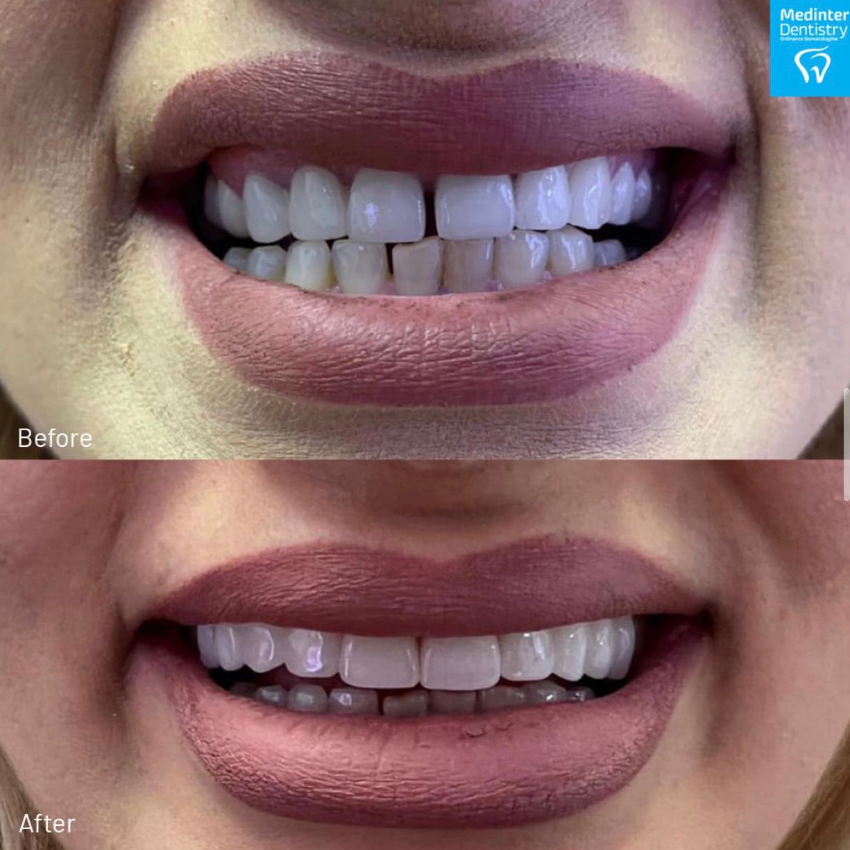 Para dhe pas trajtimit dentar
