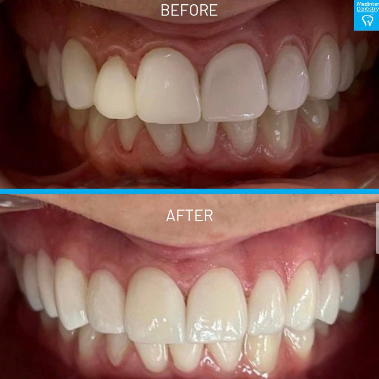 Transformim i plotë dentar